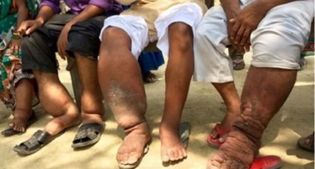 बिहार में आधी रात को लिया जायेगा आपके खून का सैंपल, सरकार इस बीमारी का लगा रही पता