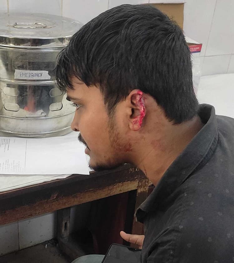 Jamshedpur News : सीतारामडेरा : घर के पास नशा करने से रोका, तो युवक का कान काटा