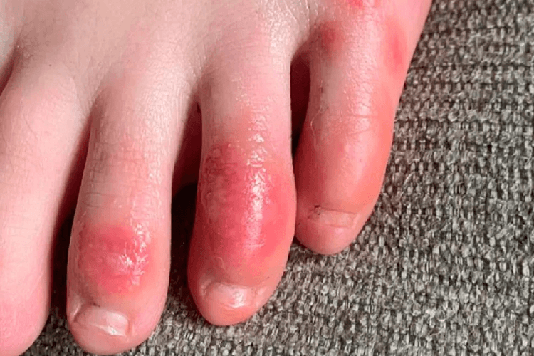 Winter Care Tips: भारी सर्दी से पैरों की उंगलियां सूज रही है? फॉलो करें ये 5 टिप्स