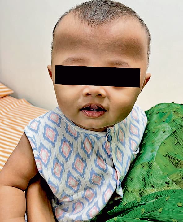 जटिल बीमारी से जूझ रहे बांग्लादेशी शिशु का हुआ सफल इलाज