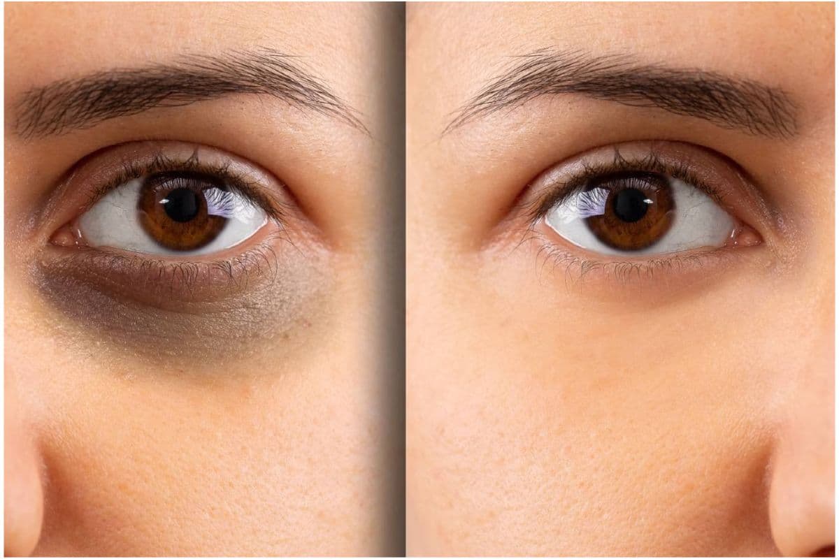 Dark Circle Remedies : डार्क सर्कल्स को कहें अलविदा, अपनाएं ये घरेलू नुस्खे