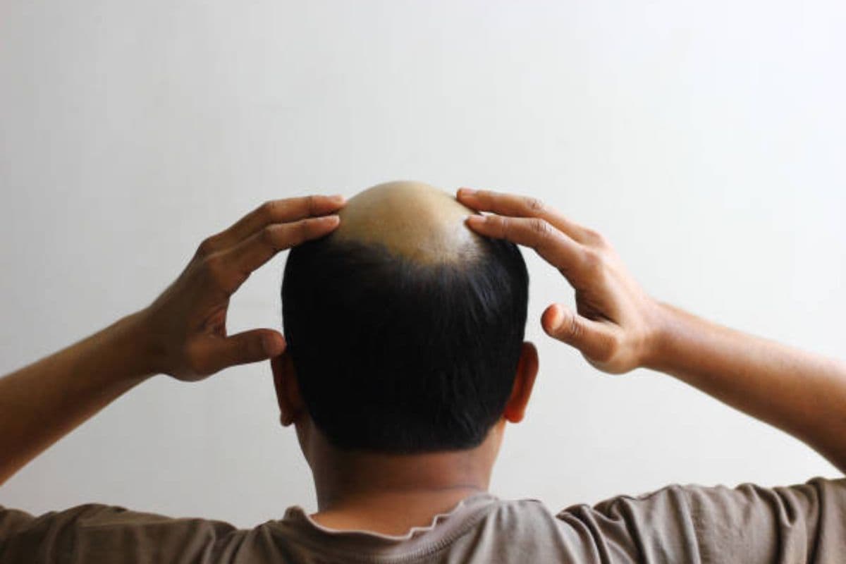 Hair Care Tips: आपका ब्लड दिला सकता है गंजेपन से छुटकारा, एक्सपर्ट ने इस थेरेपी को लेकर दी बड़ी जानकारी