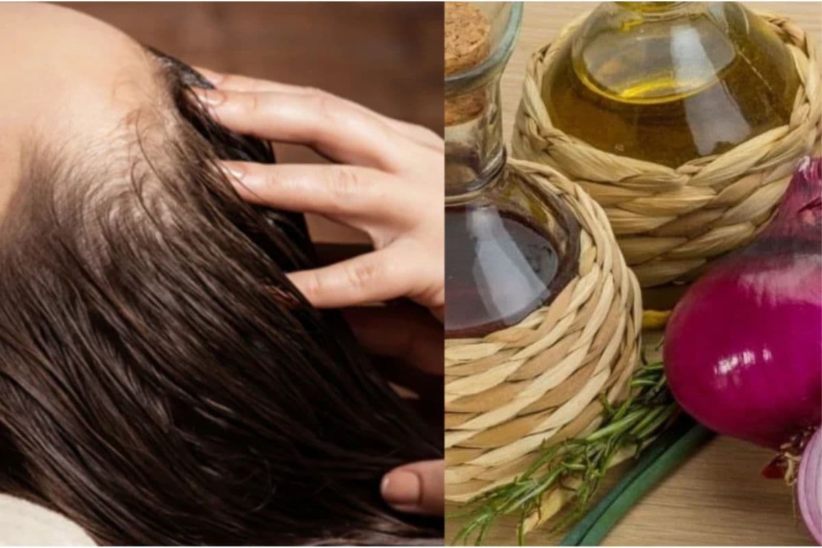Onion For Hair Fall : अगर आप भी झड़ते बालों से है परेशान तो अपनायें प्याज के यह ट्रिक्स