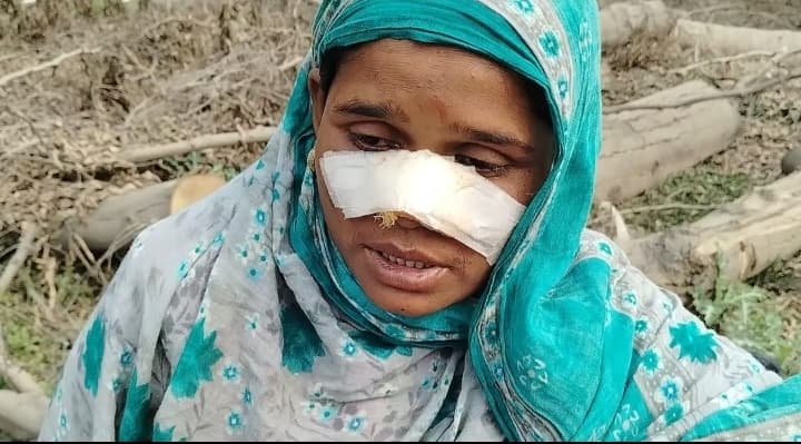 घरेलू विवाद में देवर ने चाकू से भाभी व भतीजा का नाक काटा