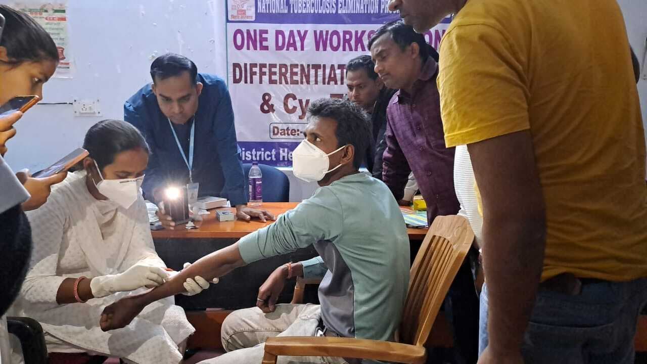 टीबी संक्रमण की जांच के लिए सीवाई टेस्ट का शुभारंभ