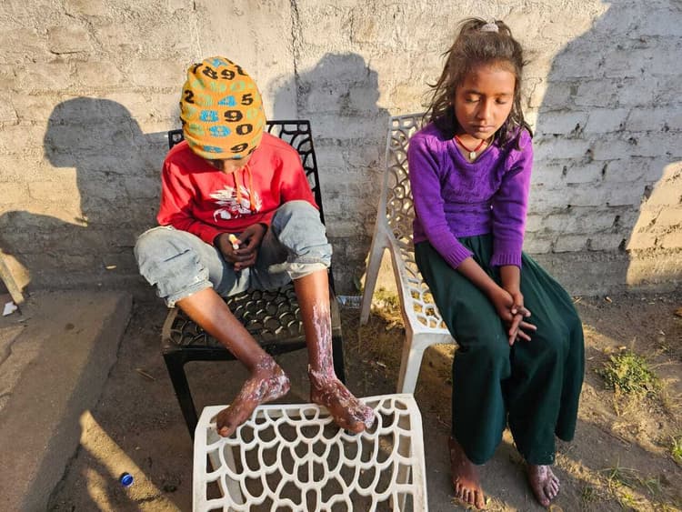 मोमबत्ती से घर में लगी आग, दो बच्चे झूलसे