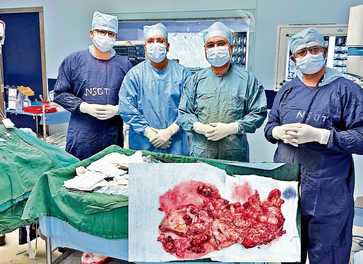 Ranchi News : मरीज की रीढ़ से एक किलो का ट्यूमर निकाला