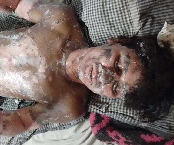 शॉट सर्किट से लगी आग में झुलसे गृहस्वामी की इलाज के दौरान हुई मौत