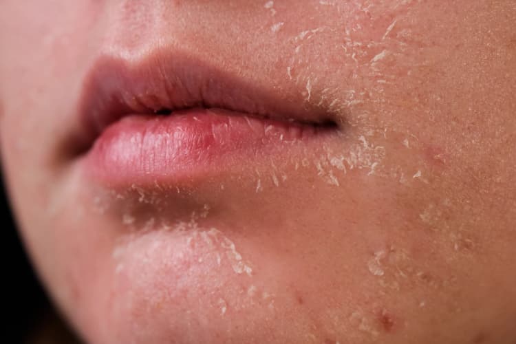 Dry Skin Care: ड्राई स्किन से परेशान हैं तो रात को बस ये चीज स्किन पर लगा लें, चमक उठेगा चेहरा