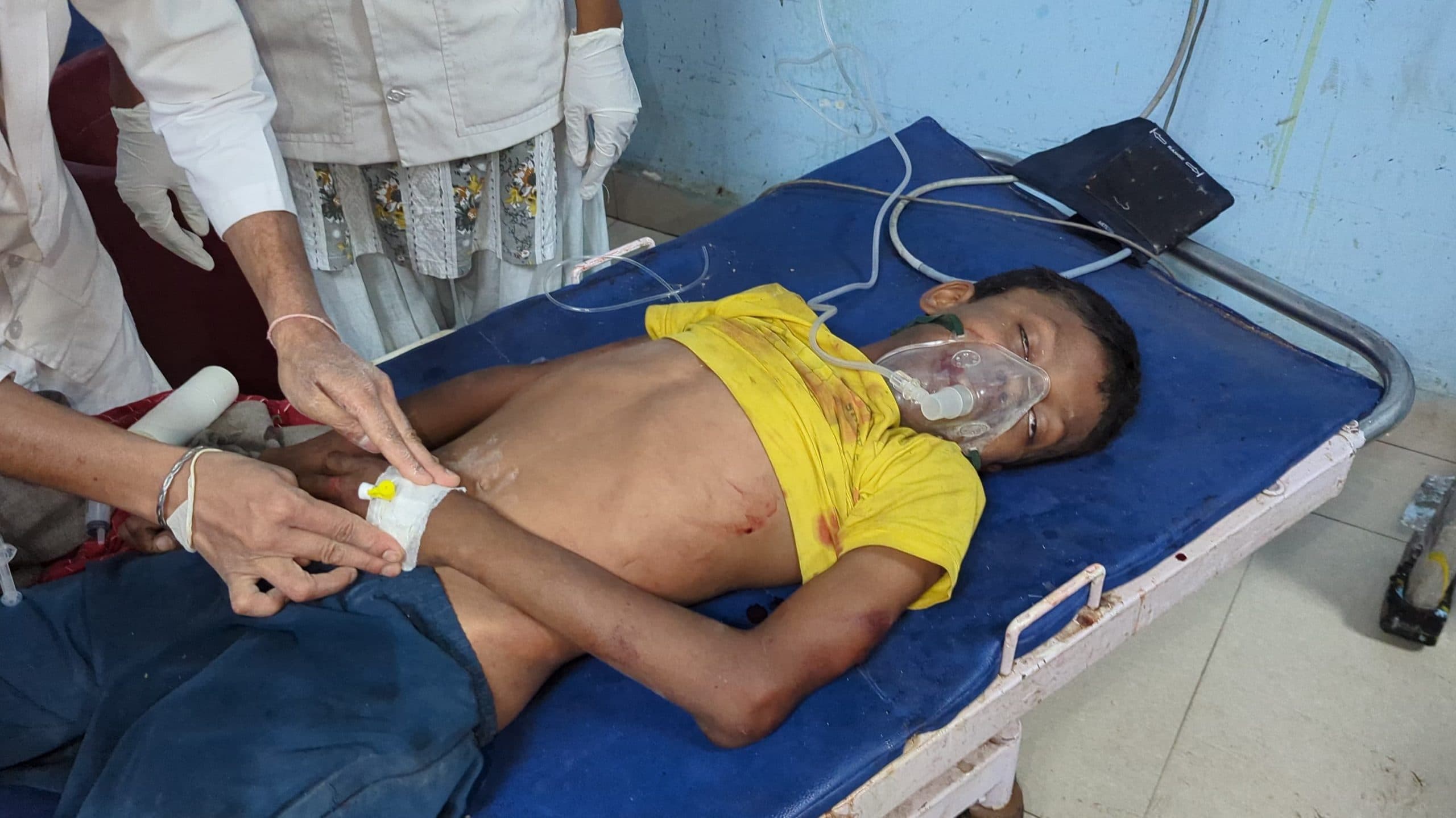 तेज आंधी-पानी के दौरान ताड़ के पेड़ गिरने से किशोर जख्मी, रेफर