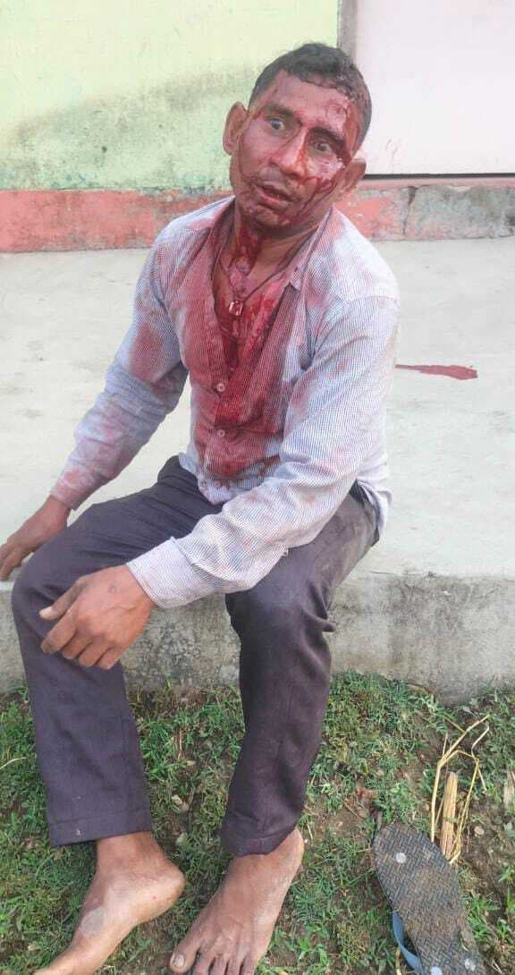 पारिवारिक विवाद में पति पर जानलेवा हमला, रांची रेफर