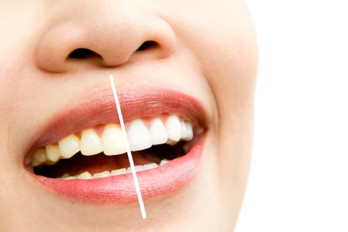Whitening Teeth: महंगे प्रोडक्ट नहीं, ये घरेलू नुस्खे बना देंगे आपके दांत मोती जैसे सफेद Whitening Teeth: महंगे प्रोडक्ट नहीं, ये घरेलू नुस्खे बना देंगे आपके दांत मोती जैसे सफेद