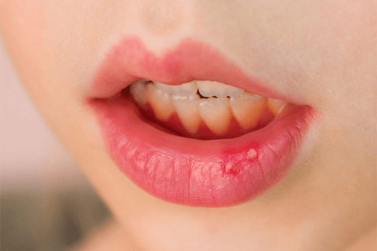 Mouth Ulcer: सिर्फ पाचन नहीं मुंह में छाले होने के हो सकते हैं अन्य कारण भी