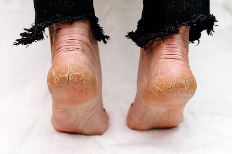 Home Remedies For Cracked Heels: गर्मियों में फटी एड़ियों से परेशान? अपनाएं ये असरदार घरेलू उपाय