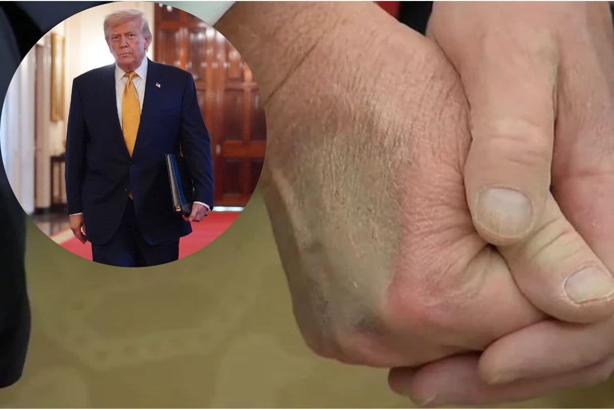 Donald Trump: पैरों में सूजन, हाथ पर निशान, किस बीमारी से पीड़ित है डोनाल्ड ट्रंप?