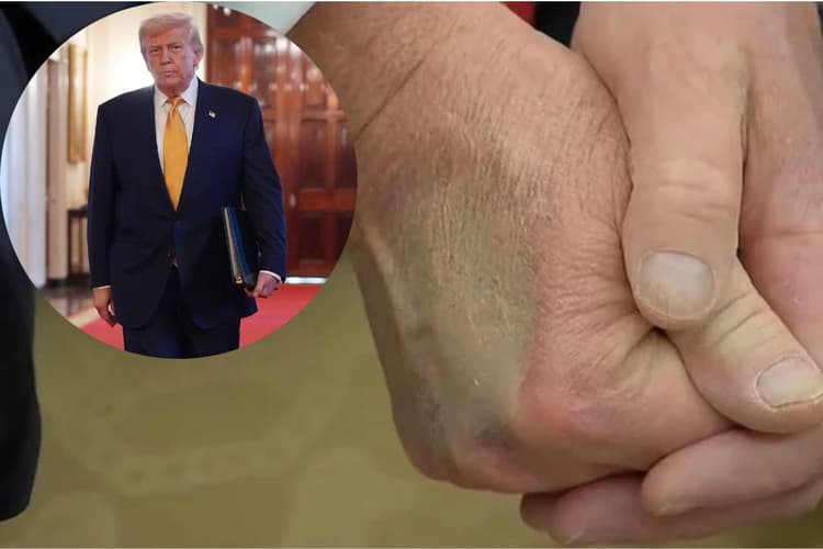 Donald Trump: पैरों में सूजन, हाथ पर निशान, किस बीमारी से पीड़ित है डोनाल्ड ट्रंप?