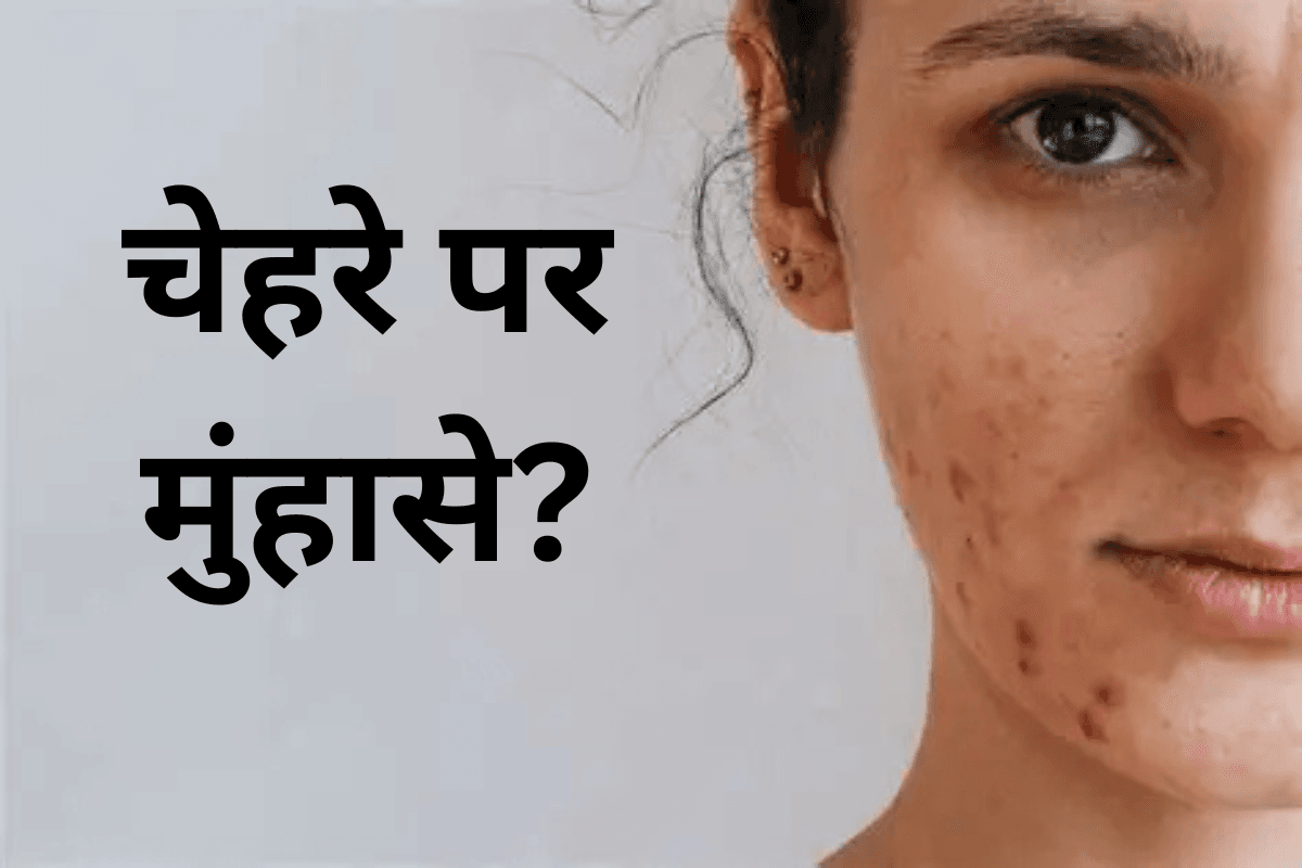 Home Remedies for Acne Home Remedies for Acne