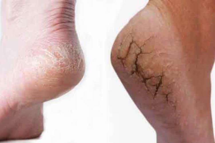 Cracked Heels Treatment: फटी एड़ियों की परेशानी? आजमाएं ये घरेलू उपाय और पाएं राहत