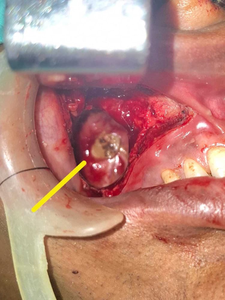 Patna News : मरीज की आंख में निकला दांत, आइजीआइएमएस में सर्जरी कर बचायी जान