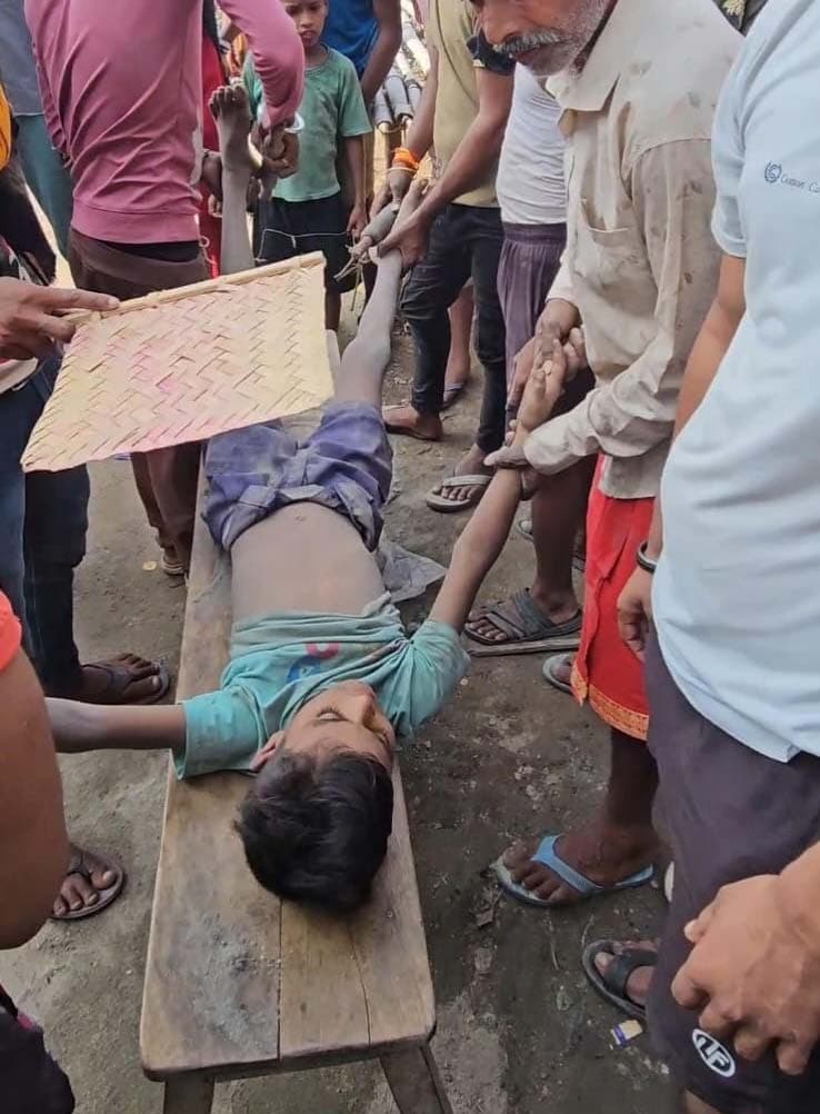 चुहरचक में सीसीटीवी पोल में करंट, 12 वर्षीय बालक झुलसा, सुरक्षा इंतजाम पर सवाल