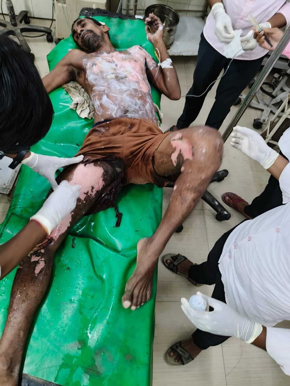 Samastipur News:हाई टेंशन तार में सटा लोहे का छड़, दो मजदूर झुलसे