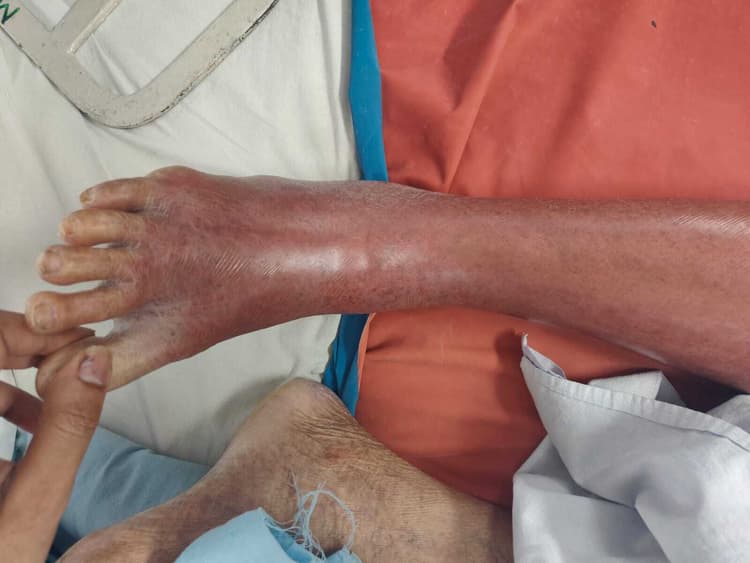 Jamshedpur News : शहर में तेजी से बढ़ रहे सेल्युलाइटिस के मामले, जानिये लक्षण और बचने के उपाय