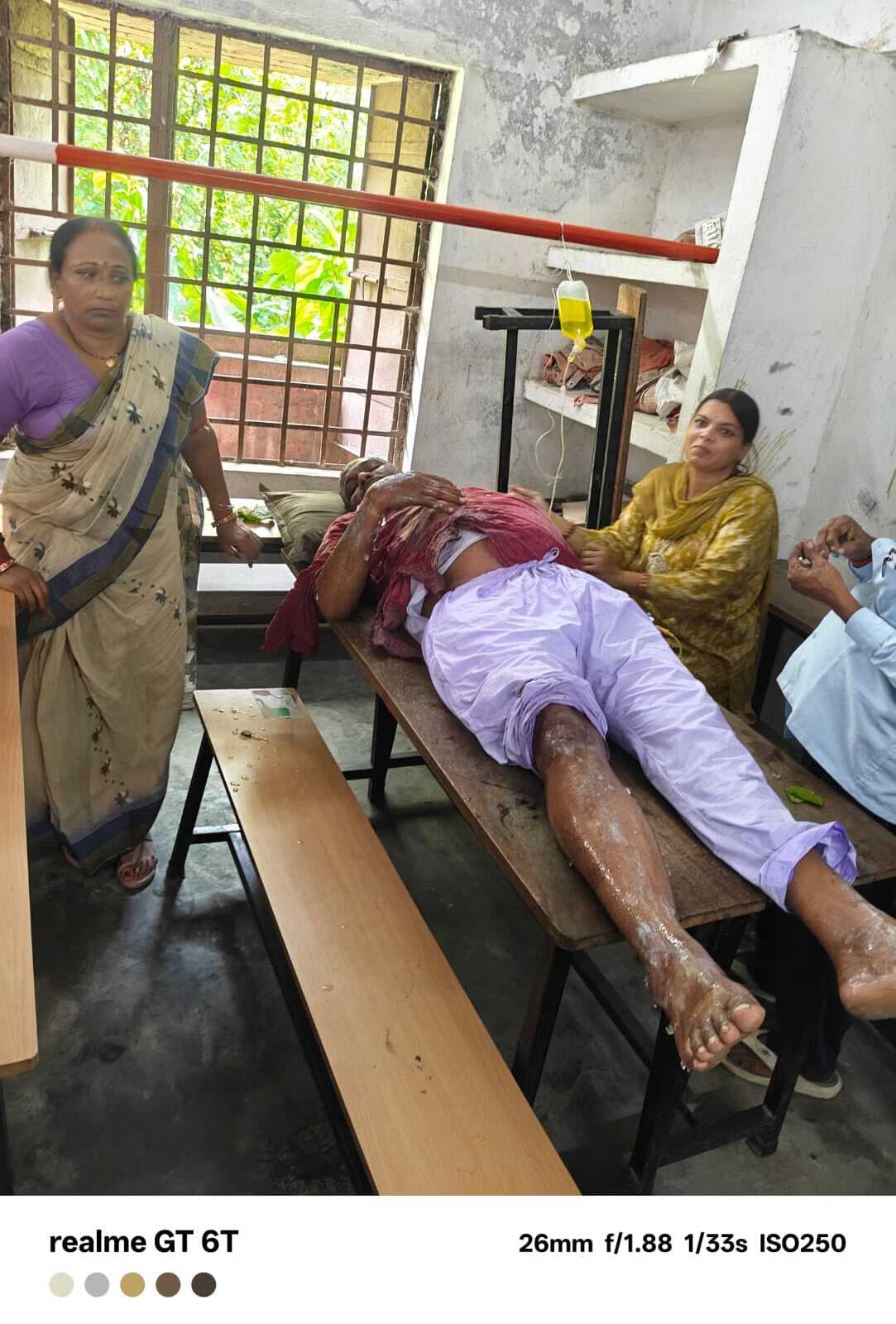 Samastipur : सिलेंडर रिसाव से लगी आग, दो रसोइया व एचएम झुलसे