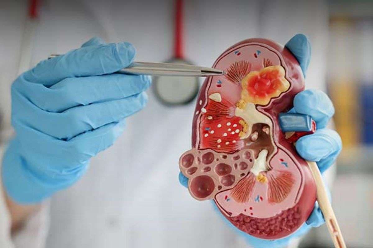 Universal Kidney Transplant Universal Kidney Transplant