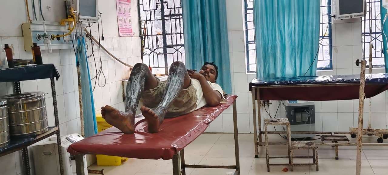 अधौरा के बरकट्ठा में पेट्रोल से लगी आग में भाई-बहन झुलसे, हालत गंभीर