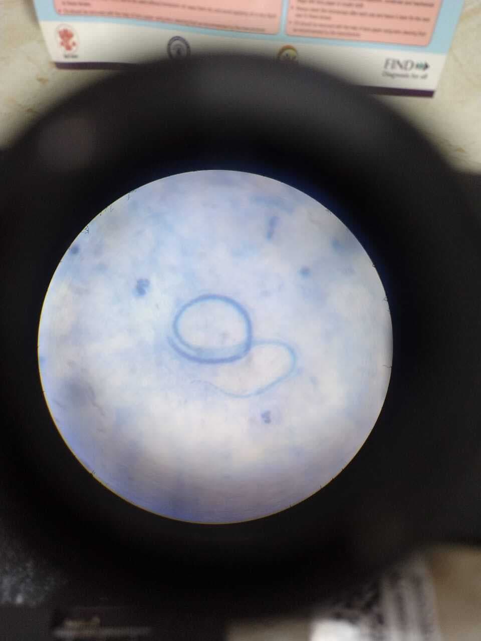 गुरुआ के गुडरू गांव में पिता-पुत्र में मिले माइक्रोपरजीवी