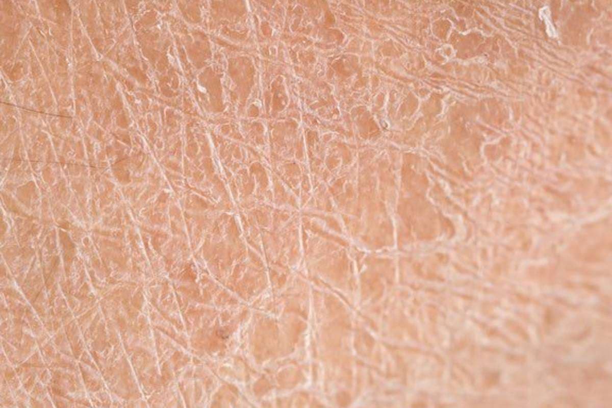 Best Home Remedies for Flaky Skin Treatment Best Home Remedies for Flaky Skin Treatment