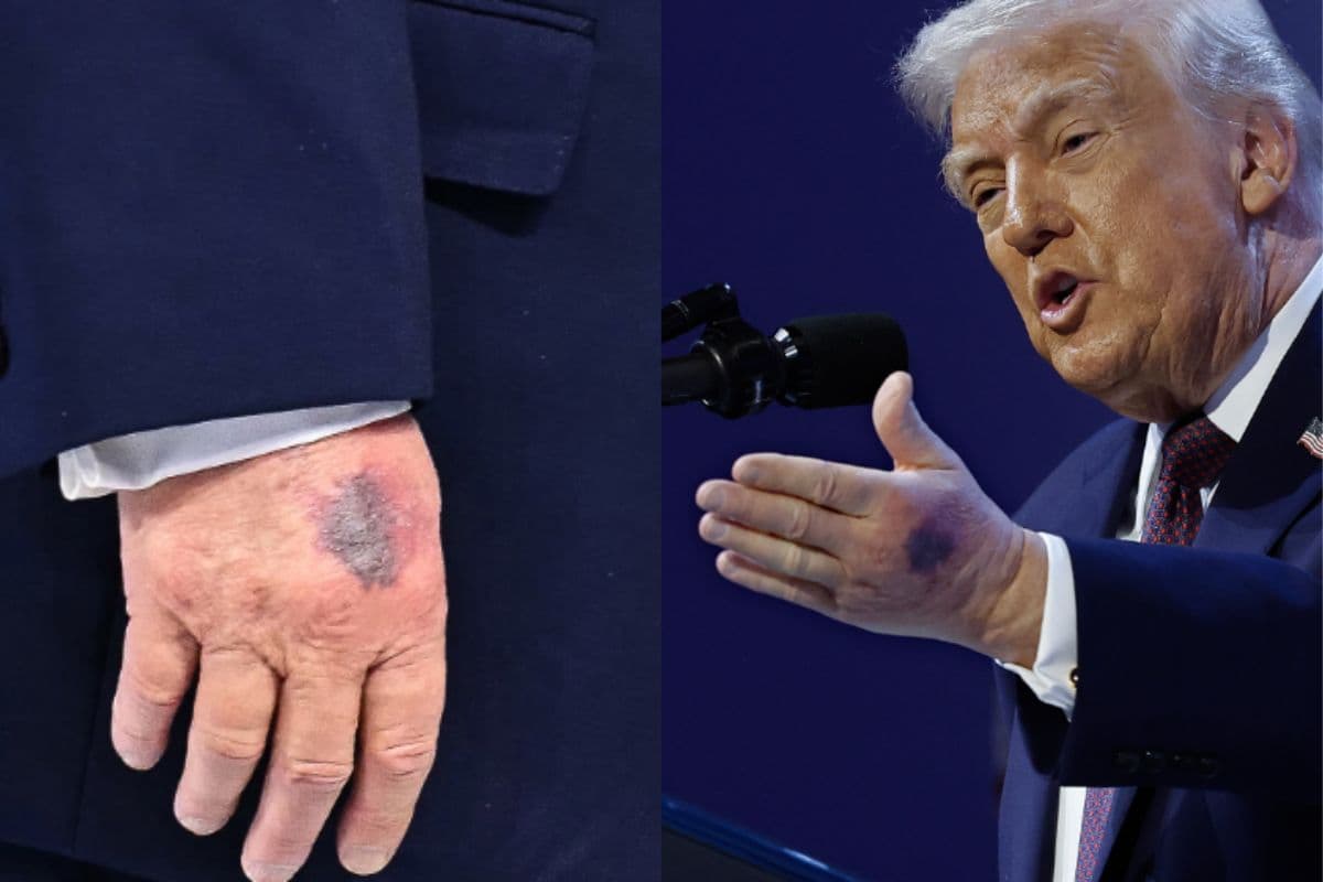 क्या हुआ है ट्रंप के हाथों को? दावोस समिट में दिखे चोट के निशान; बीमारी की चर्चाओं के बीच घिरे अमेरिकी राष्ट्रपति