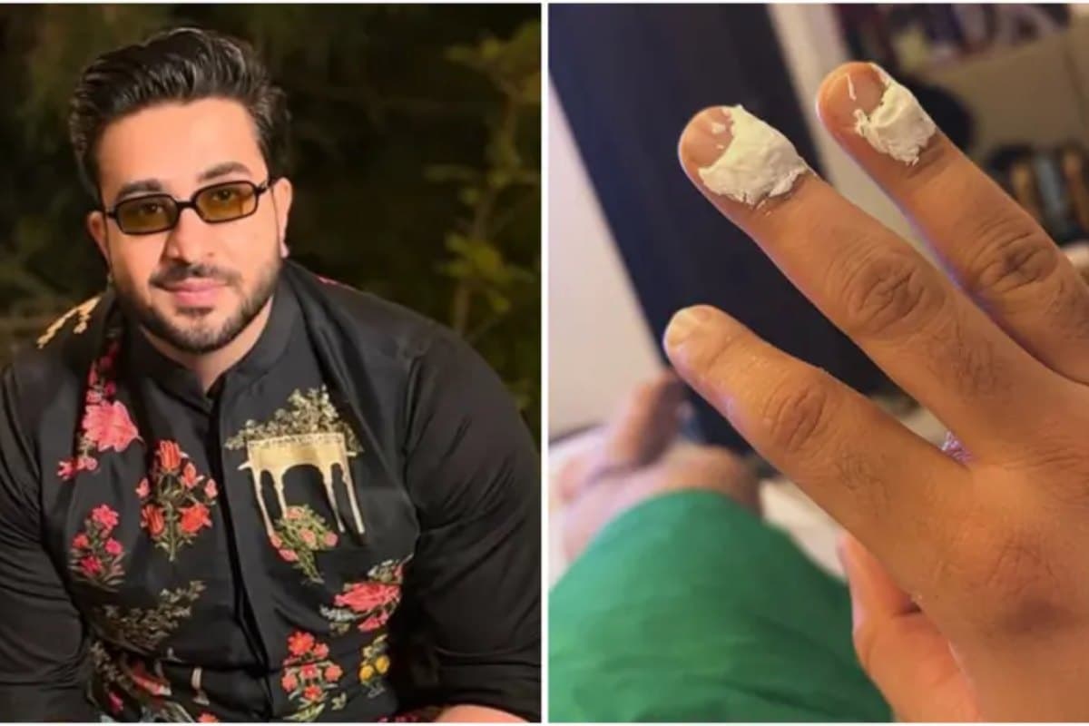 Laughter Chefs 3 aly goni burns hand during laughter chefs 3 shoot reacts humorously
