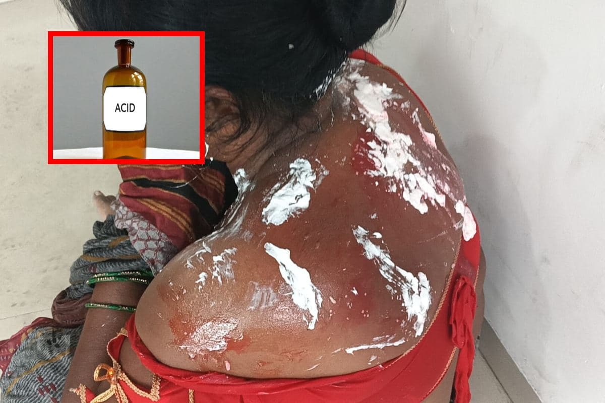 मुजफ्फरपुर: सब्जी बेच रही महिला पर गरम लिक्विड से अटैक, पीठ और चेहरा झुलसा