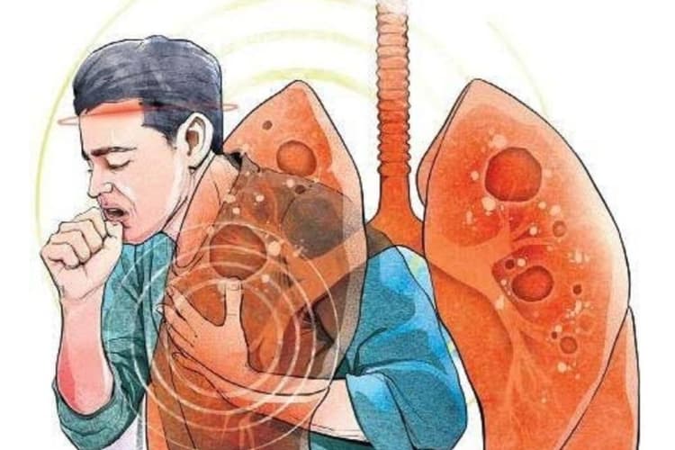 दो साल बाद टीबी मरीजों को बड़ी राहत, अब 30 दिन की मुफ्त दवा एक साथ मिलेगी