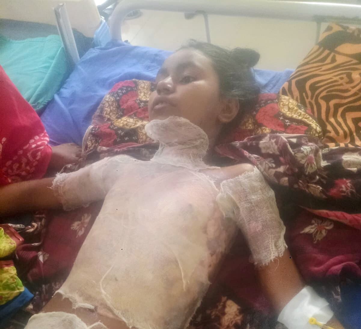 पटाखे की चिंगारी से सिरसा गांव की बच्ची झुलसी, अजहर इस्लाम ने ली सुध