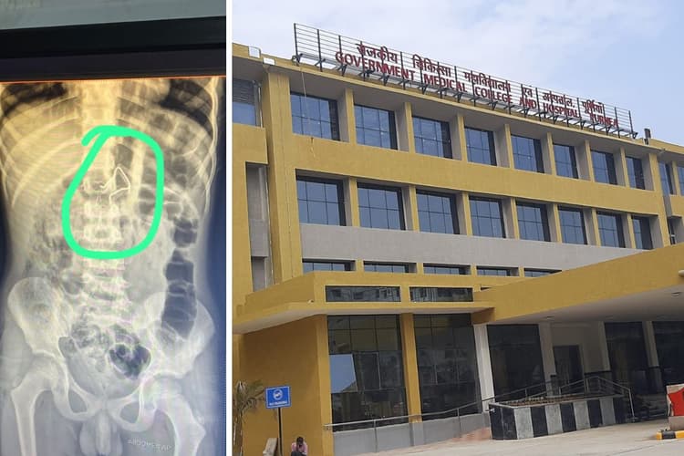 जीएमसीएच में चमत्कार, 6 साल के बच्चे की आंत में फंसा स्प्रिंग बिना चीरा लगाए निकाला