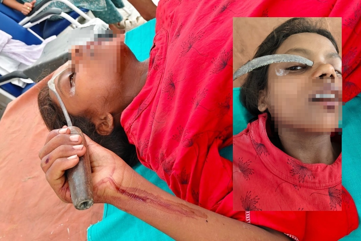Muzaffarpur: खेत जाने के दौरान पैर फिसला: बच्ची की आंख और चेहरे को चीरता हुआ अंदर घुसा हंसुआ, SKMCH में मिली नई जिंदगी