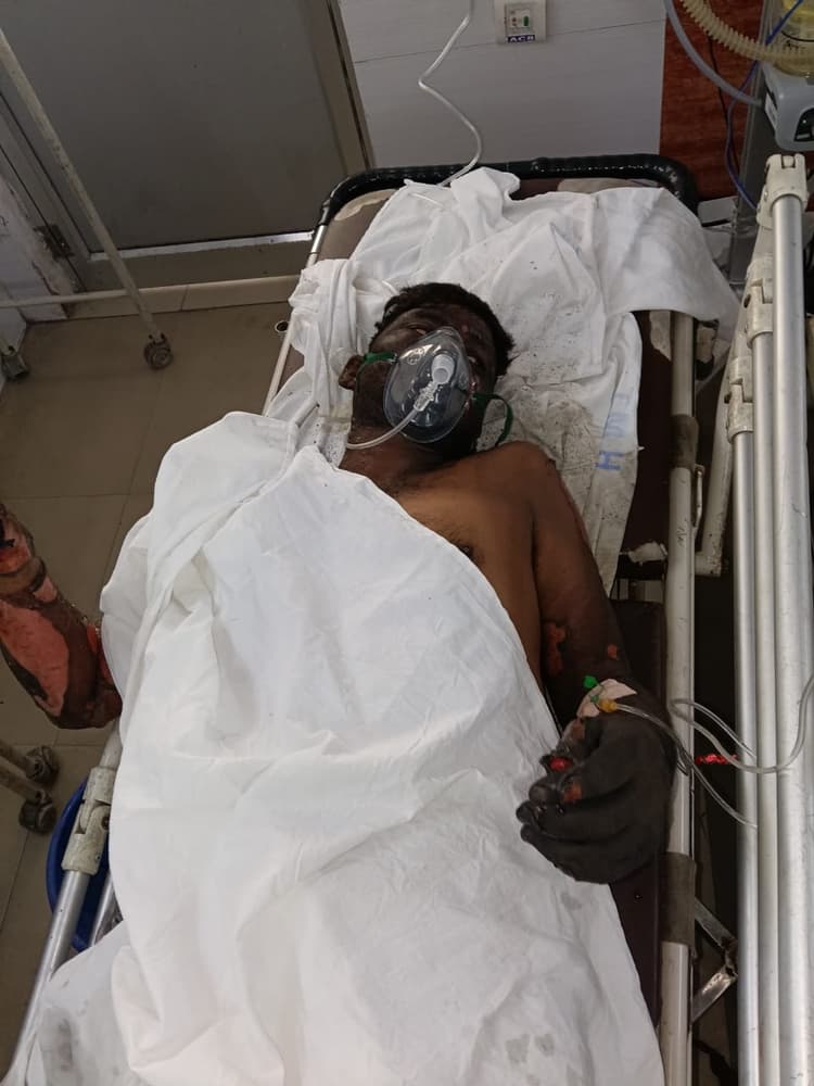 गैलेक्सी इंगोट प्लांट के फर्नेस में ब्लास्ट, बिहार के दो मजदूर झुलसे, हालत गंभीर
