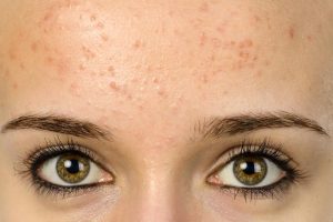 Pimples on Forehead in Summer