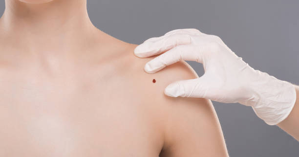 Meaning Of Moles On Body: क्या आपके शरीर पर है भाग्यशाली तिल? जानें कितने Lucky हैं आप 4 Istockphoto 1161363902 612X612 1