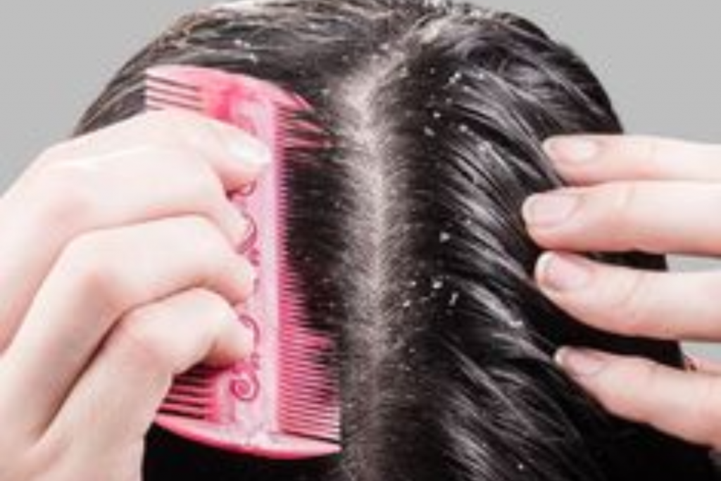 Tips To Avoid Dandruff In Winter: सर्दी के आते ही दिखने लगी है रूसी तो करें ये उपाय 1 Dandruff 1