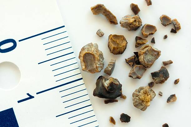 Health Tips: पथरी गलाता है पत्थरचट्टा का पत्ता, इस्तेमाल करने का जानें सही तरीका 1 Istockphoto 476148769 612X612 1