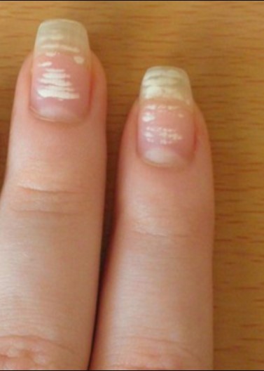 Why we get white spots under our nails - Alltop Viral